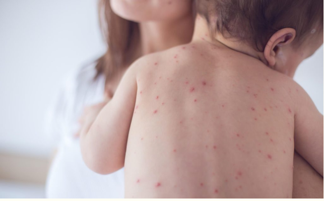 No país: São 9.898 casos de sarampo confirmados neste ano