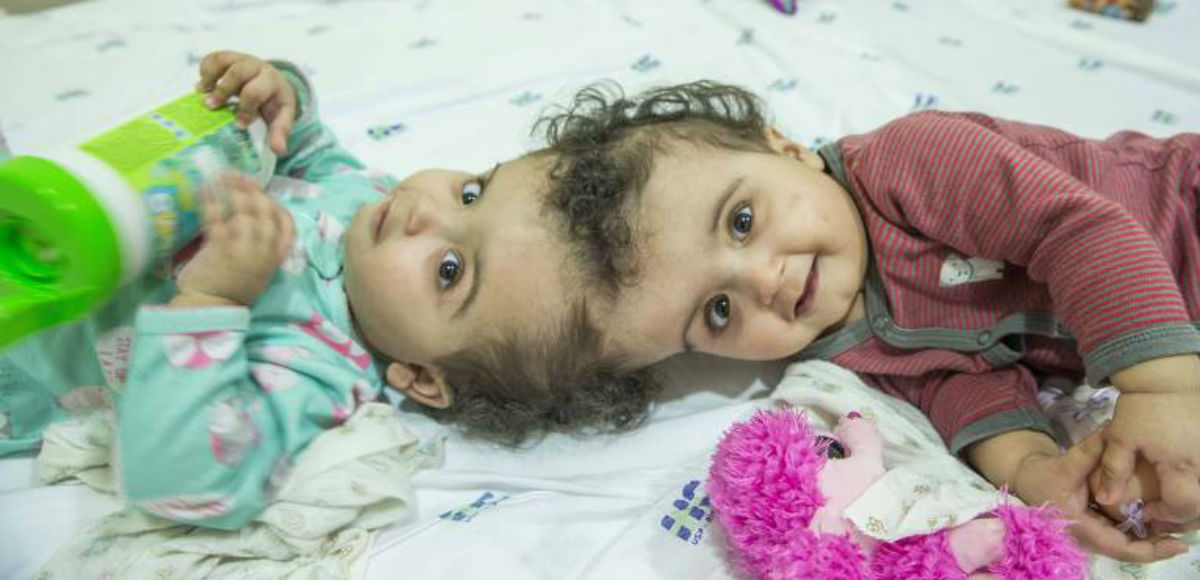 Inédito no Brasil: 40 dias após cirurgia, gêmeas siamesas recebem alta