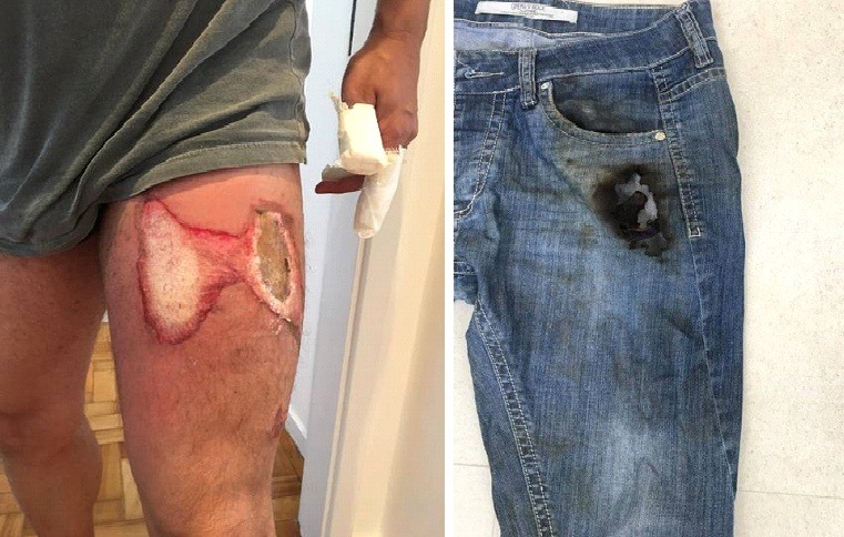 No país: Celular pega fogo no bolso da calça e deixa homem com queimaduras na perna e mãos