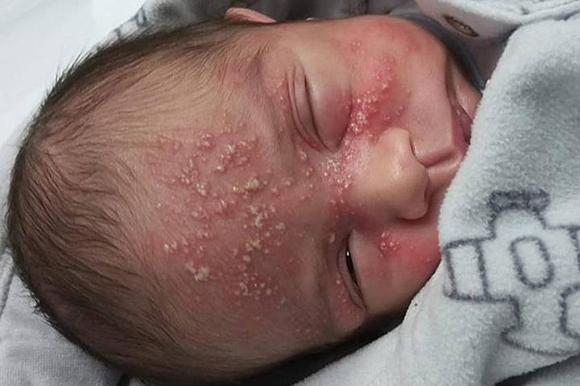 Prevenção: Herpes em bebês pode levar à morte