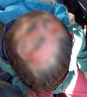 No país: Criança acusa pai e madrasta de queimarem a cabeça dela com ferro de passar