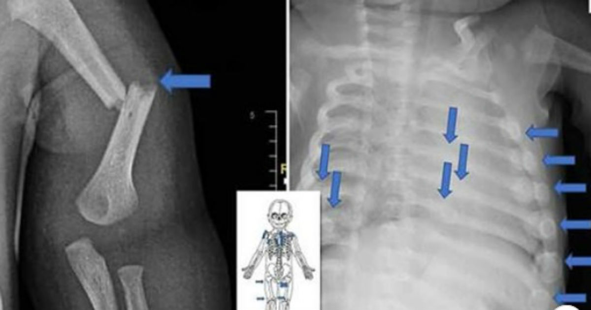 Internacional: Bebê de 4 meses sofre 28 fraturas após ser agredido pelos pais