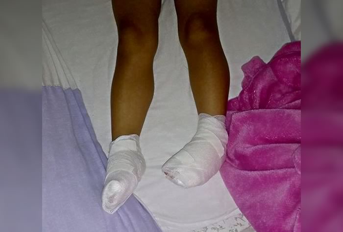 Em SC: Criança tem queimaduras de 2º grau nos pés após ser deixada descalça no pátio de creche 