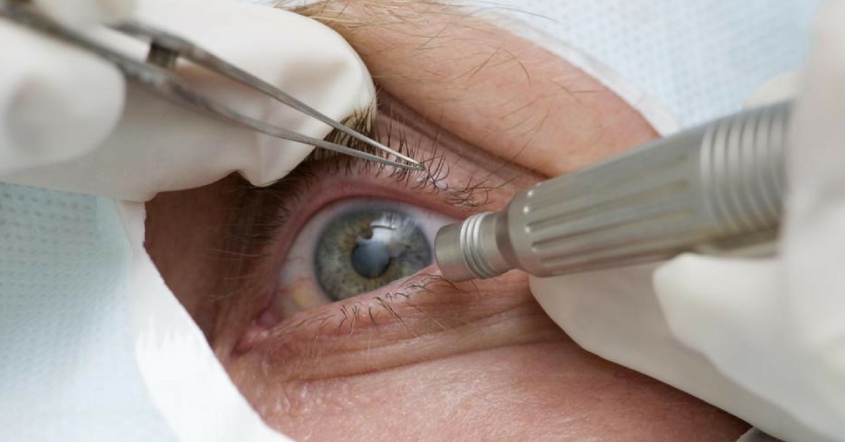 Mutirão da catarata: cerca de 200 tubaronenses vão realizar o procedimento