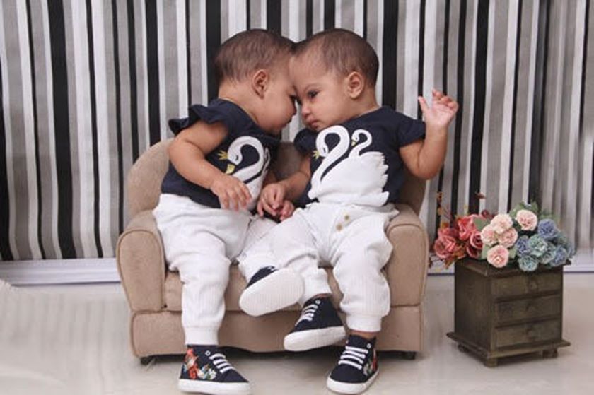 No país: “Virão outras batalhas, mas esta a gente venceu”, diz mãe de siamesas