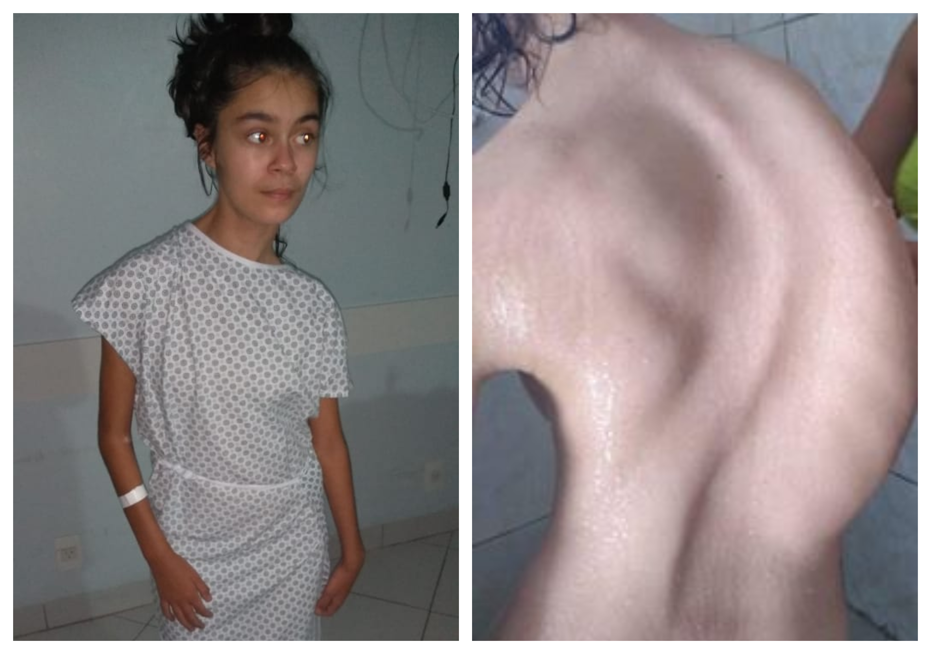 “Todos pela Cíntia”: após mais de 10 horas de cirurgia, adolescente se recupera na UTI