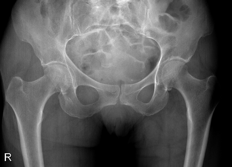 Paciente de Imbituba que ficou com material cirúrgico no corpo após exame será indenizada