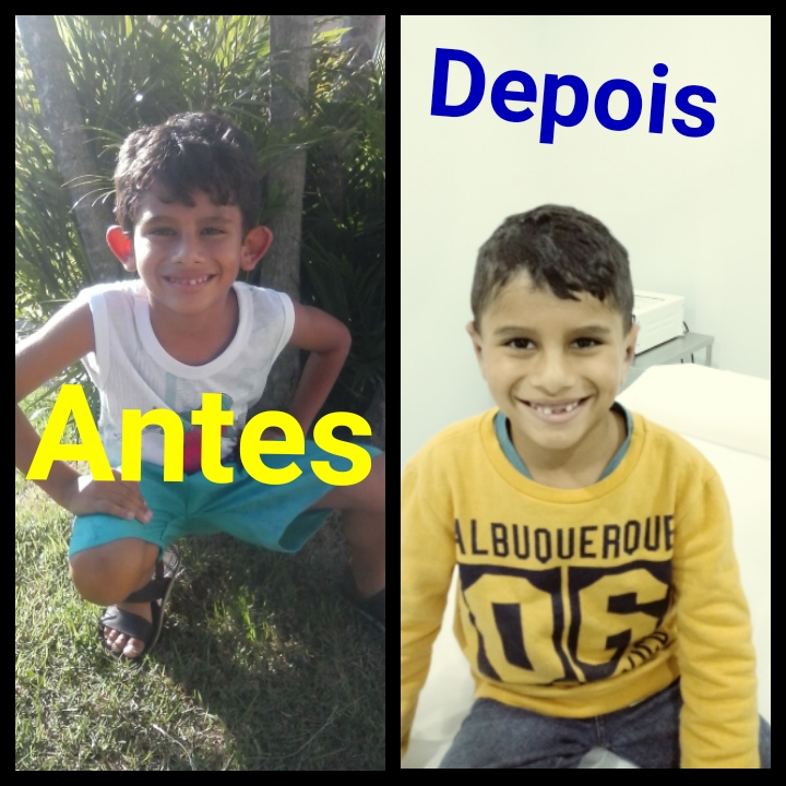 Jaguaruna: Menino que sofria bullying faz cirurgia nas orelhas