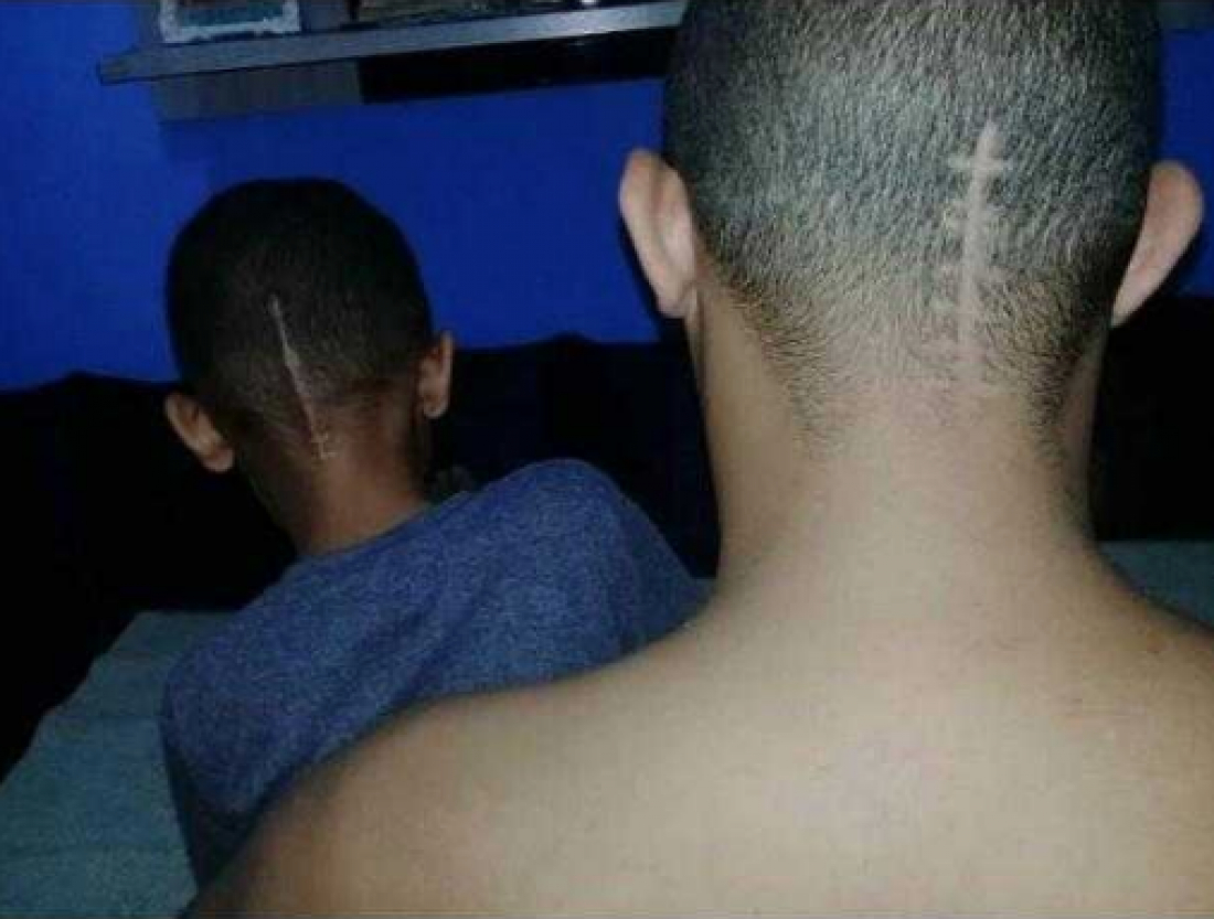 No país: pai faz corte de cabelo imitando a cicatriz da cirurgia do filho