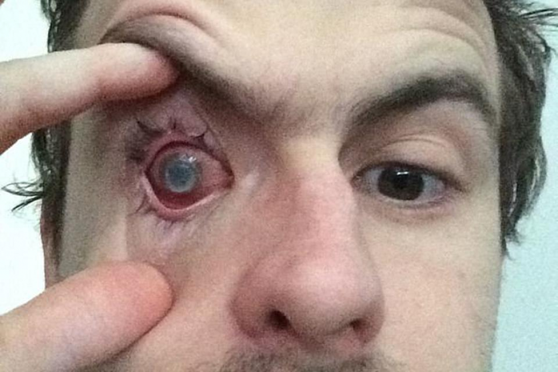 Internacional: jovem fica cego de um olho após tomar banho usando lente de contato