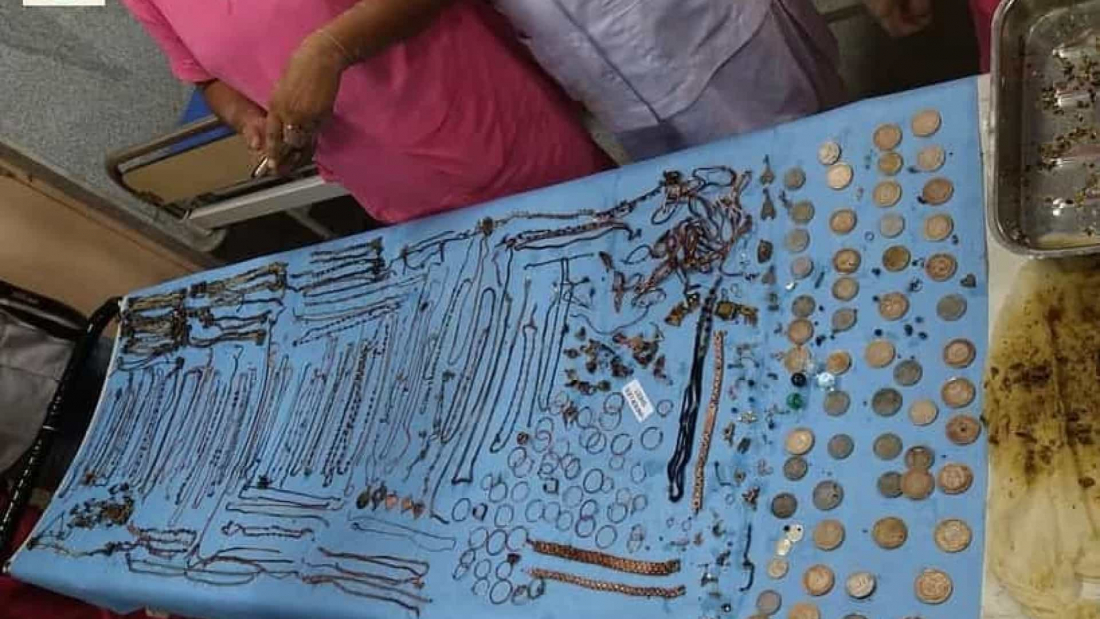 Internacional: médicos retiram 220 peças de joias de estômago de doente compulsiva