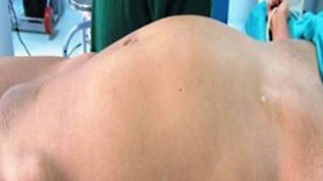 Caso raro: médicos descobrem que 'tumor' no abdômen de adolescente é gêmea parasita