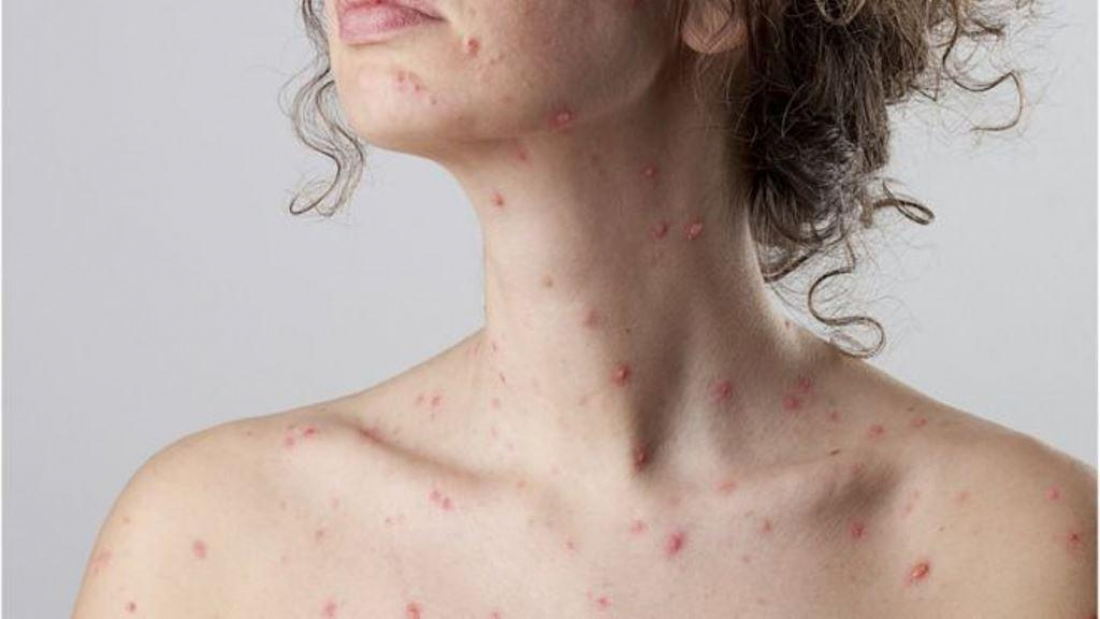 Paciente com suspeita de sarampo é atendida em Garopaba