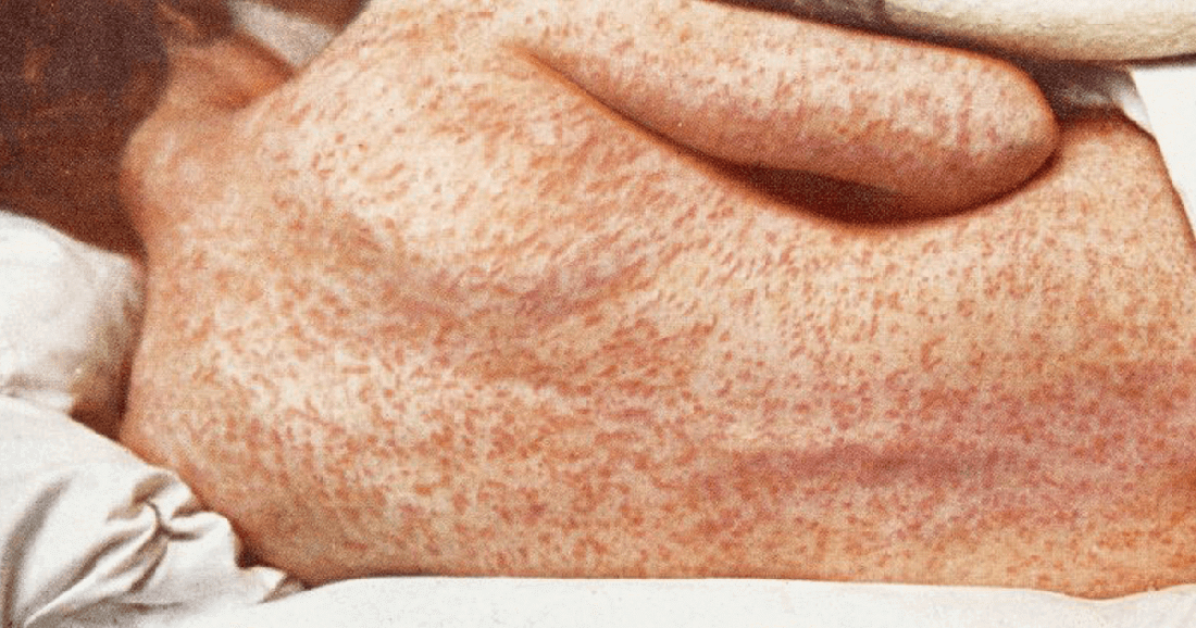 Fundação Municipal de Saúde confirma três casos de sarampo em Tubarão