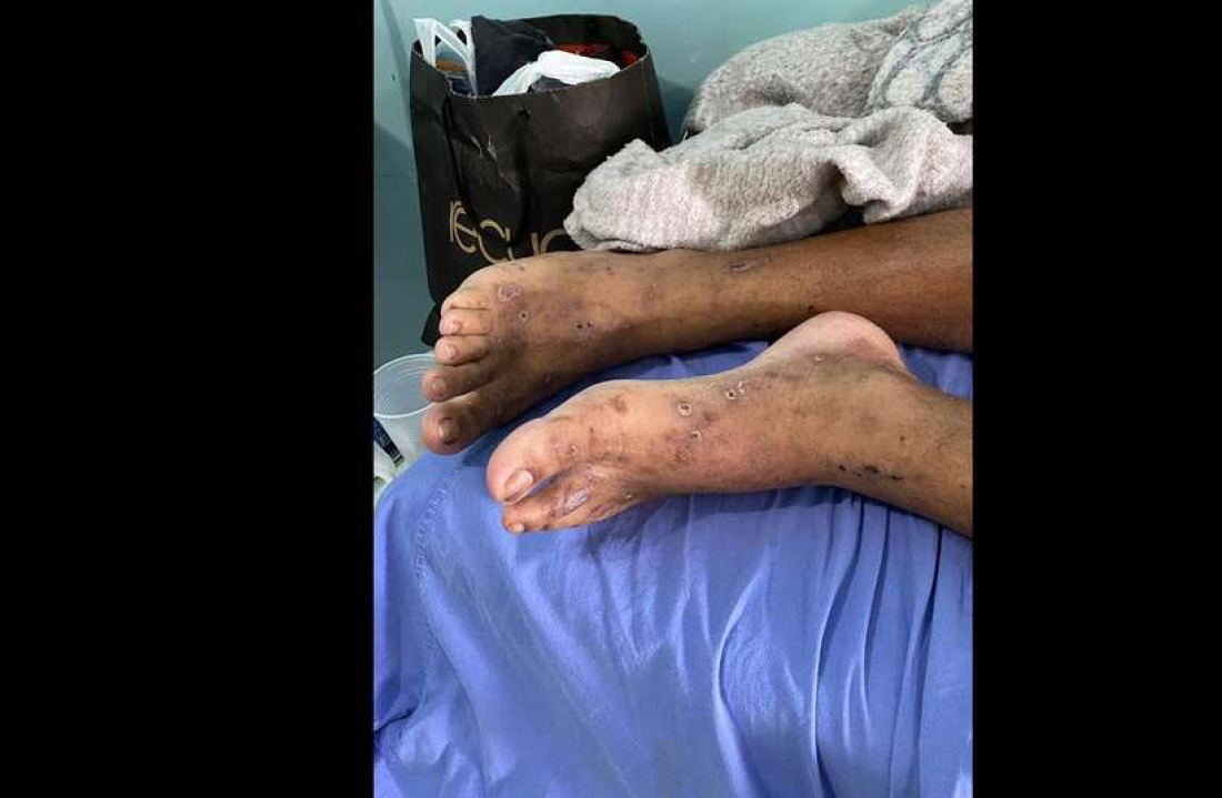 No país: detentos são 'comidos vivos' por bactéria desconhecida