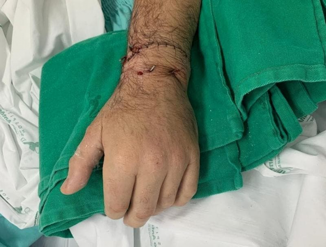 Em SC: Em cirurgia rara, mão de homem é reimplantada após ser amputada em briga