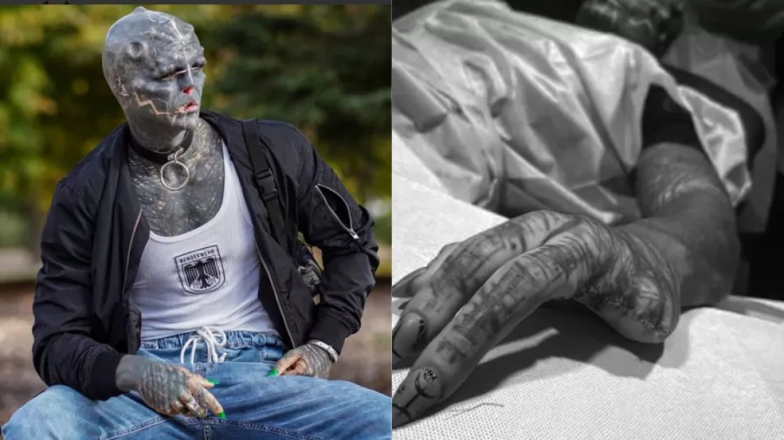 Internacional: Homem amputa os dedos para se parecer mais com 'alienígena sombrio'