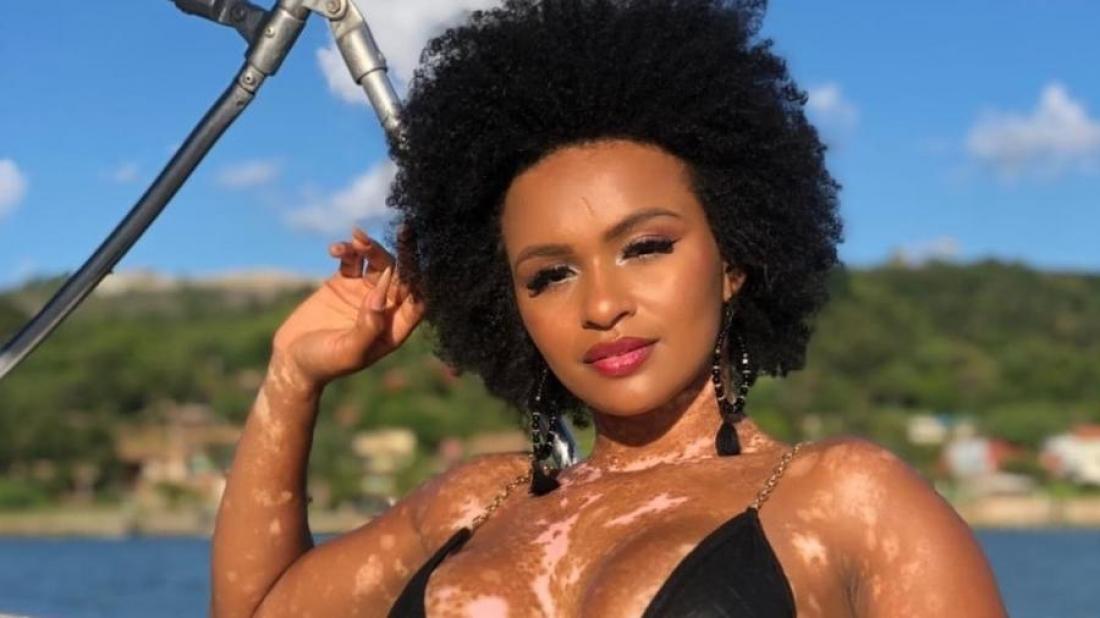 Vitiligo: entenda a doença de pele de Natália, do BBB 22