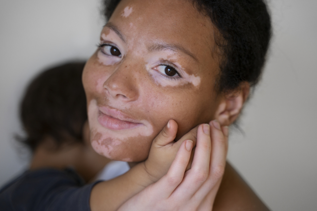 A vida a duas cores: dia 25 de junho é o dia mundial do Vitiligo