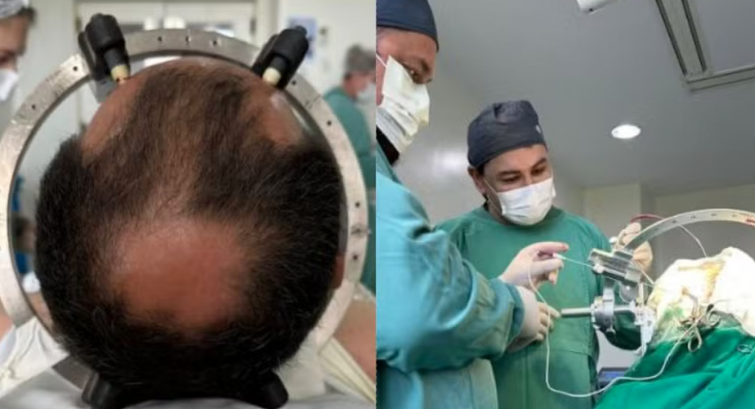 Microchip cerebral para tratamento de TOC é inserido pela 1ª vez em SC: 'Avanço importante', diz médico