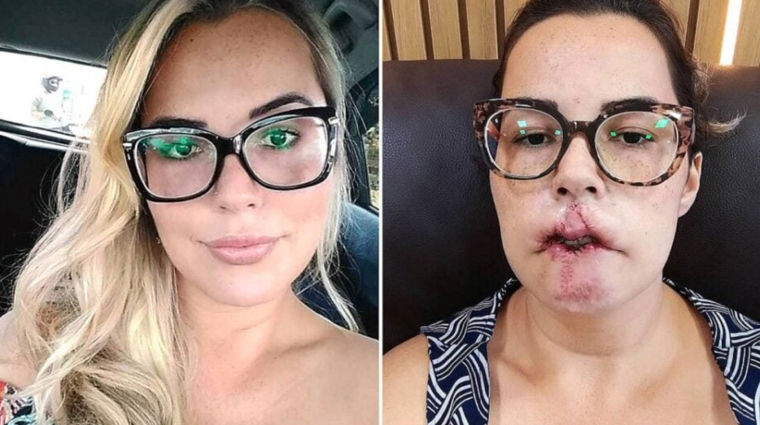 No País: Mulher perde o lábio superior após realizar harmonização facial com PMMA