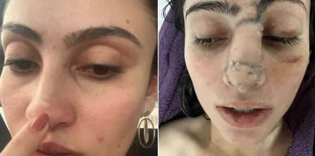 Brasil: jovem descobre câncer raro após confundir sinal no nariz com espinha interna