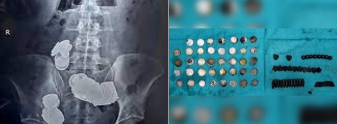 Mundo: Fisiculturista engole 37 imãs e 39 moedas para absorver zinco em seu organismo