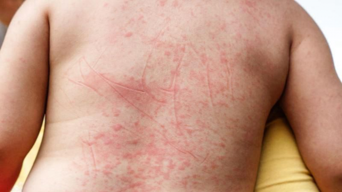 Dia 'D' contra a dengue: dedique dez minutos para proteger sua família