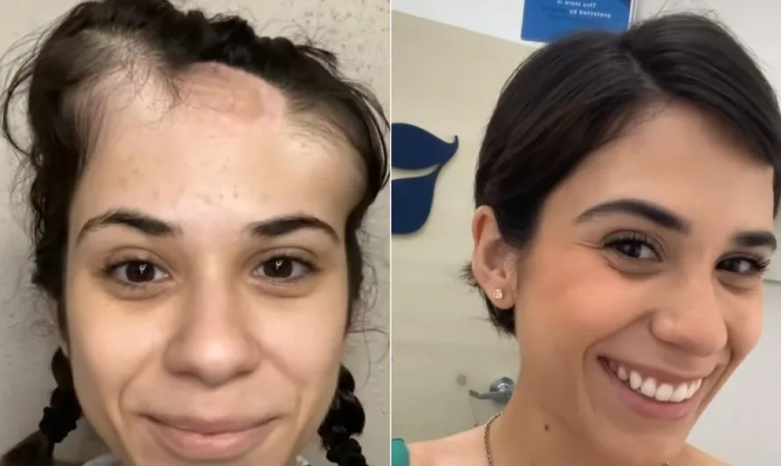 Inspirador: jovem compartilha antes e depois do tratamento para um tumor na cabeça