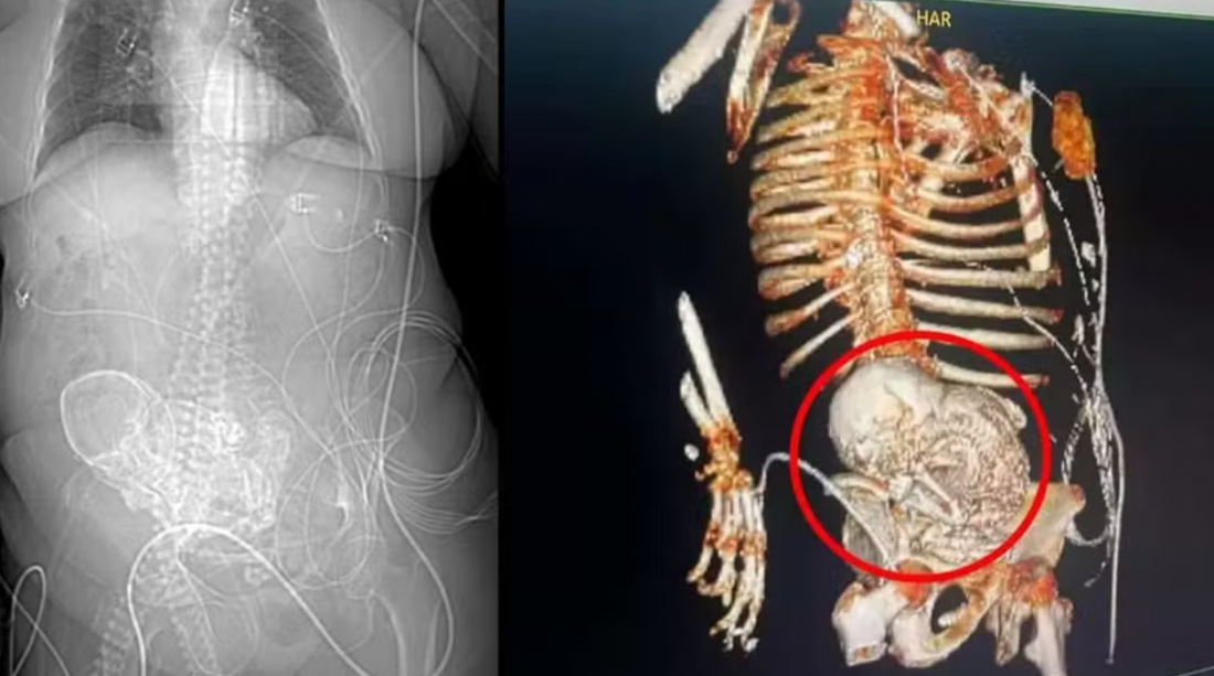 'Bebê de pedra': idosa descobre feto calcificado que carregou por mais de 5 décadas