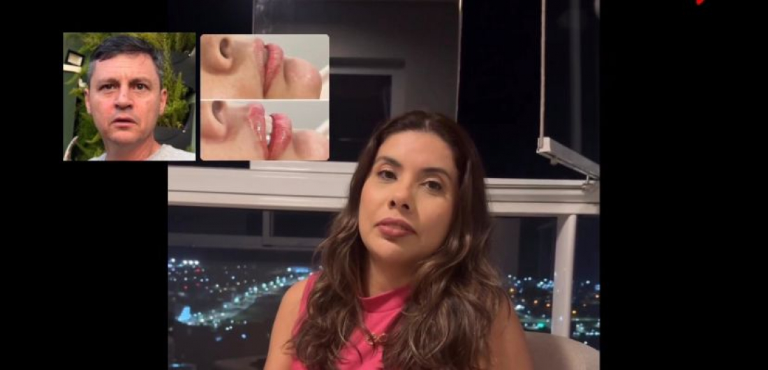 (Vídeo) Influencer mostra resultado do preenchimento labial após reação hilária que viralizou