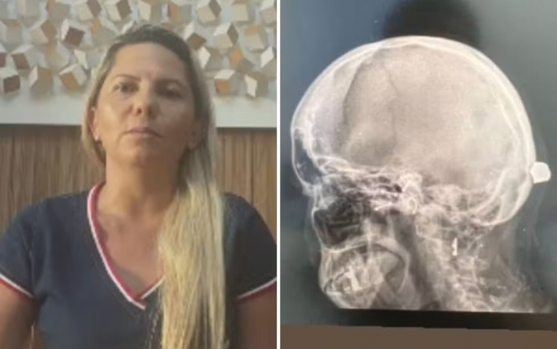 Brasil: mulher é atingida por tiro e bala fica contida no couro cabeludo; suspeito não foi identificado