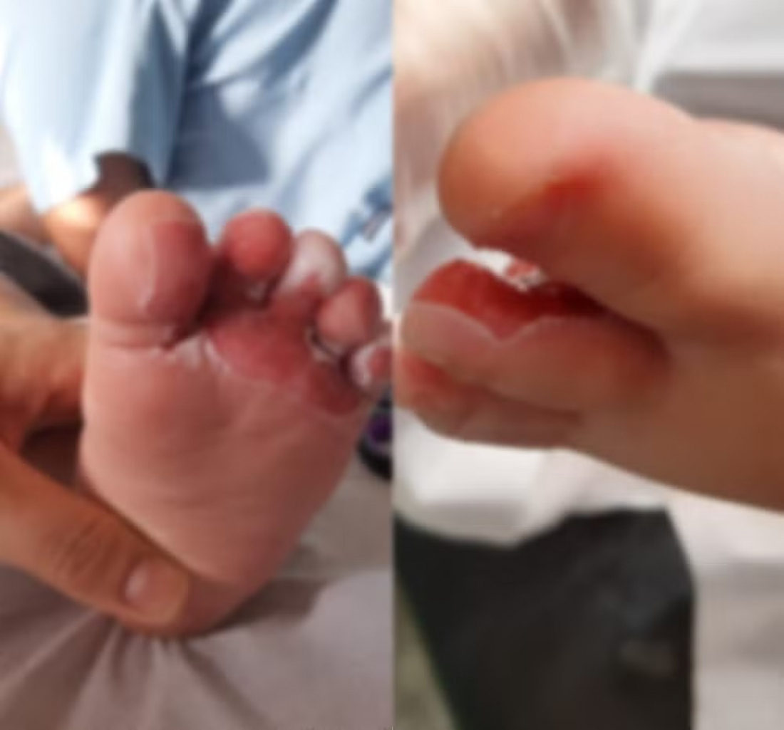 Mãe relata queimaduras de 2º grau em bebê durante banho em creche de Criciúma