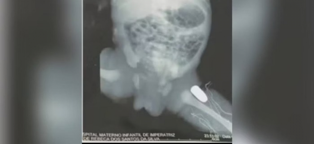 Brasil: grávida é baleada e projétil fica alojado na perna do bebê