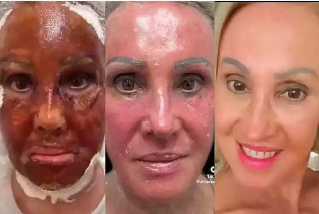 Anvisa proíbe temporariamente venda e uso de produtos à base de fenol