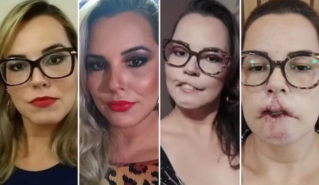 Em SC: Influencer que perdeu lábio em harmonização passa por novo enxerto