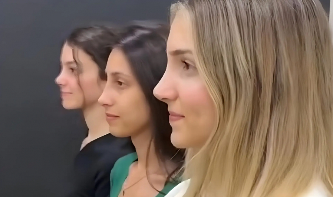 (Vídeo) Irmãs passam por rinoplastia e resultado triplo surpreende a web; assista