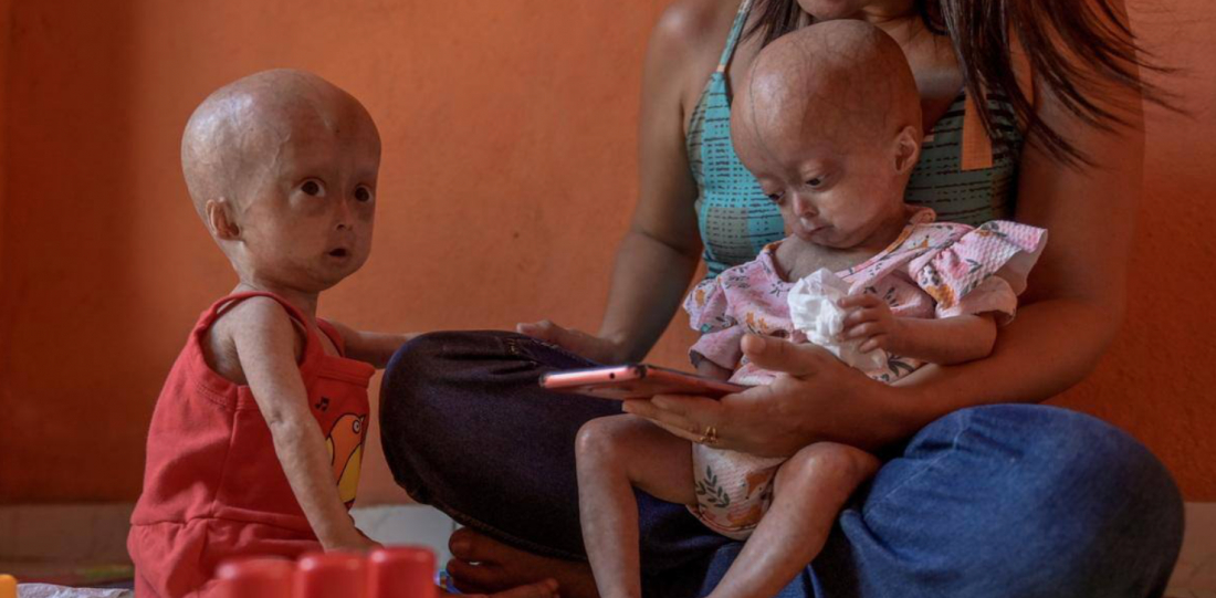 Elis e Eloá: conheça a história das gêmeas com a síndrome da velhice precoce