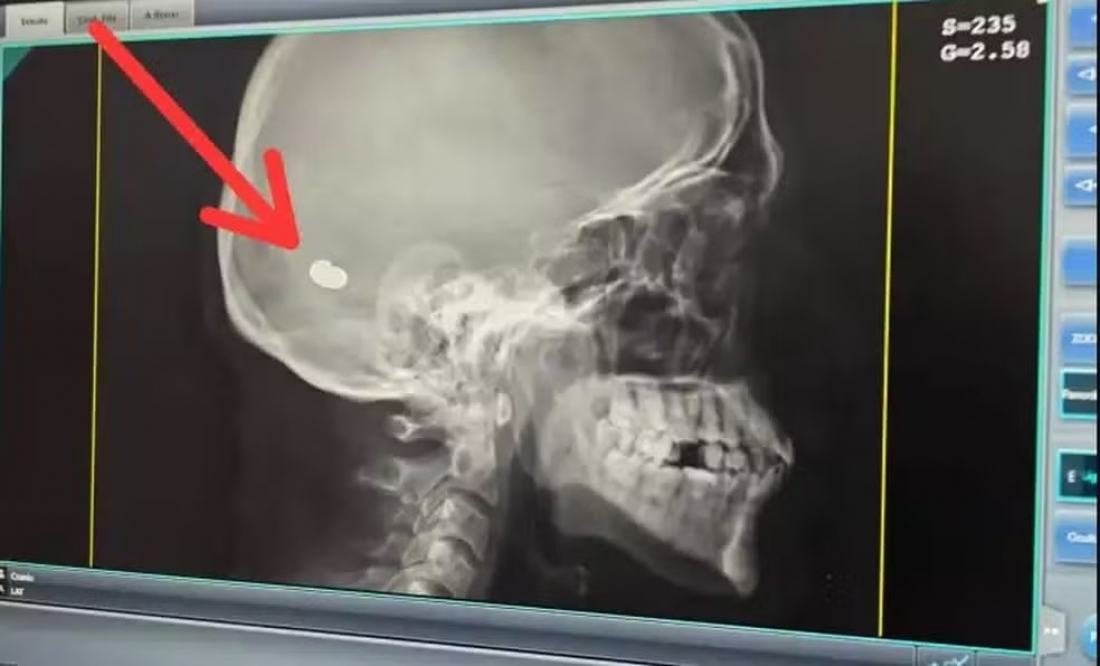 Em SC: raio-x mostra possível projétil alojado no crânio de paciente que relatou dor de cabeça