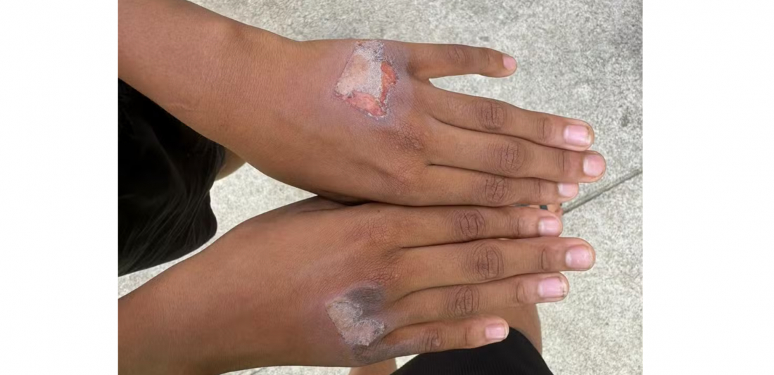 Mãe é denunciada após supostamente queimar mãos de filho com chapinha: 'comeu iogurte sem permissão'