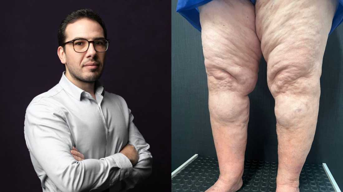 Lipedema: a condição que tem ganhado destaque com relatos de famosas