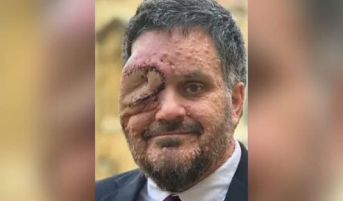 Homem com doença rara é expulso de restaurante e desabafa: ‘Assustando os clientes’