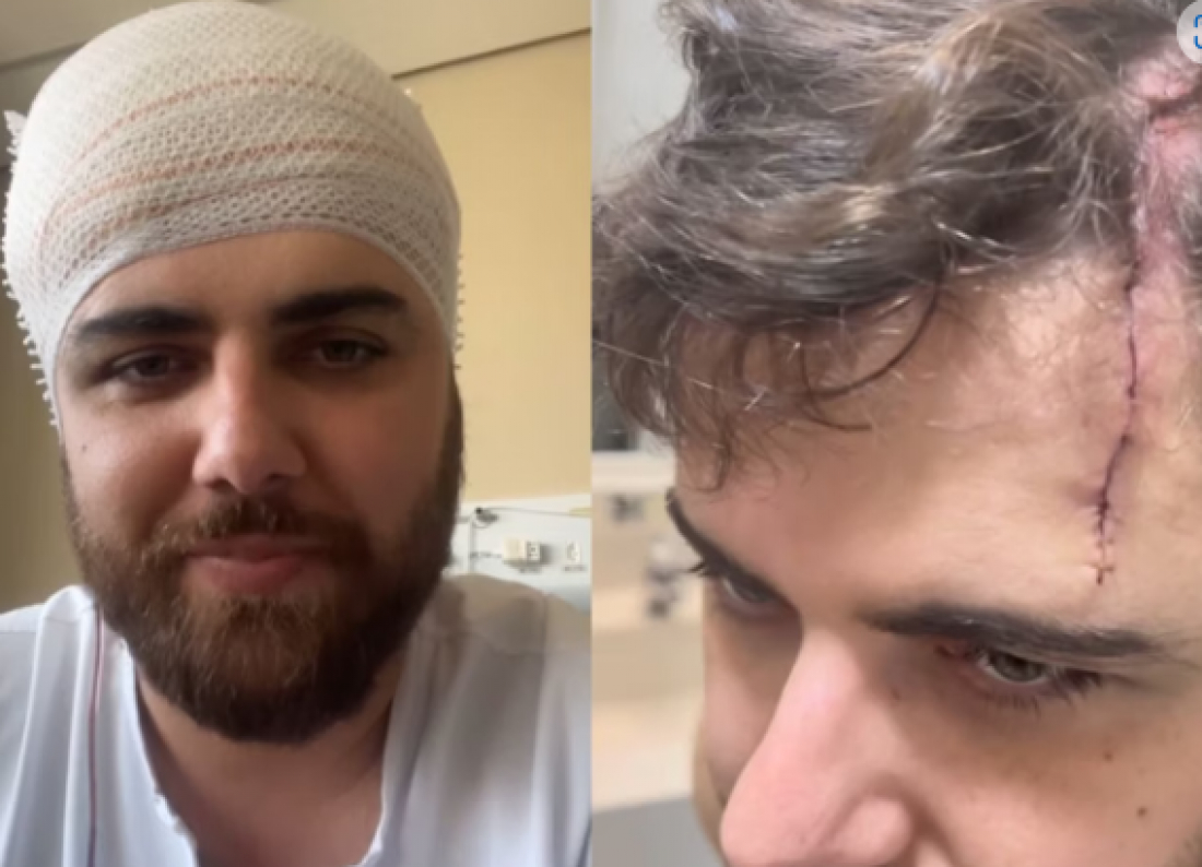 (Vídeo) Imagens fortes: Zé Neto mostra grande corte na cabeça após acidente