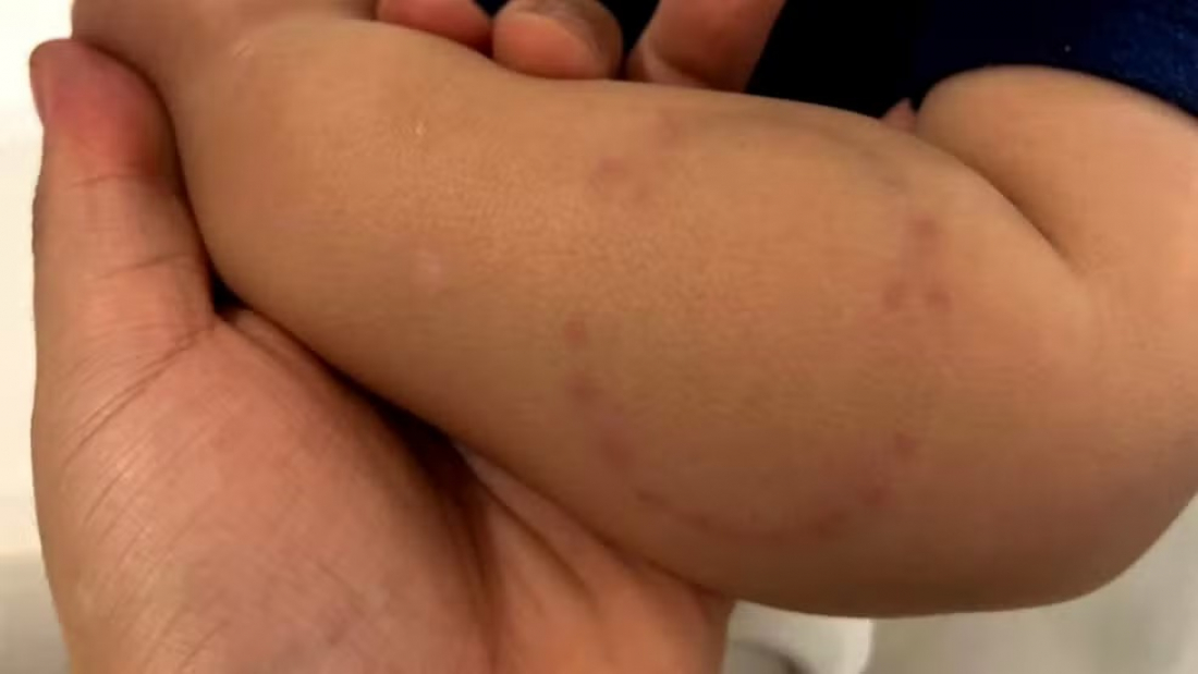 Auxiliar de berçário morde braço de bebê; “isso me destruiu”, diz mãe