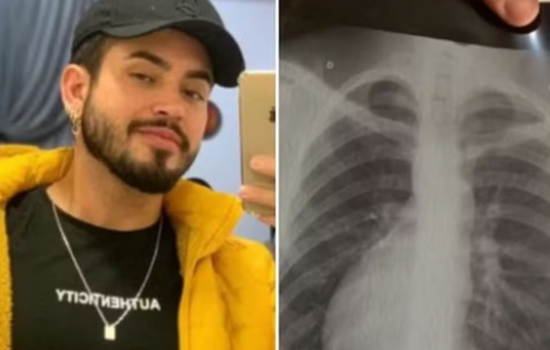 Em SC: Cabeleireiro descobre 'órgãos invertidos' após desconforto abdominal