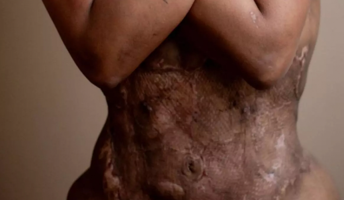 Em SC: Cirurgião plástico é indiciado por deformações irreversíveis em paciente em Florianópolis