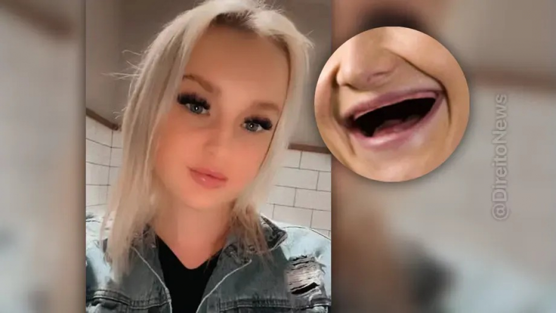 Mundo: mulher leva coice de cavalo durante o trabalho, perde 13 dentes e pede indenização de R$ 7 milhões