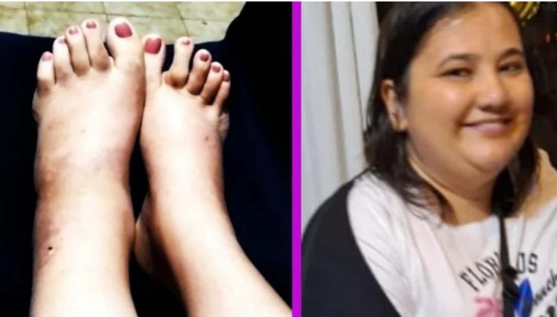 Moradora de Tubarão cria vaquinha para arrecadar R$18 mil para cirurgia e evitar amputação do pé