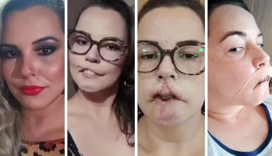 Influencer que perdeu lábio após uso de PMMA passa por 3º enxerto para reconstrução do rosto: 'Vamos vencer'