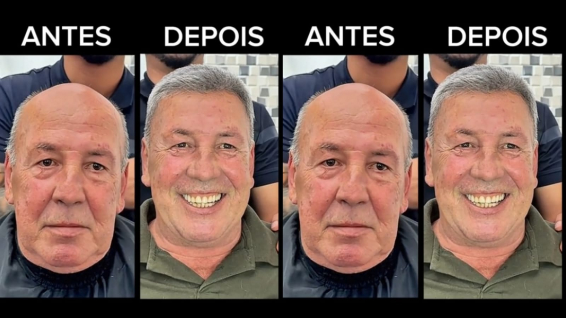 Empresário tubaronense Edinho coloca prótese capilar com influencer famoso e viraliza